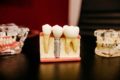 The Advantages Of A Dental Implant
